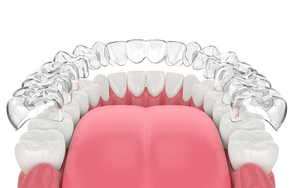 Beta-Dental-Empfehllung-Invisalign